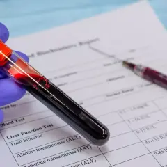 Ręka w niebieskiej rękawiczce trzyma probówkę z krwią, obok leży strzykawka i wyniki badań. To badanie krwi u psa.