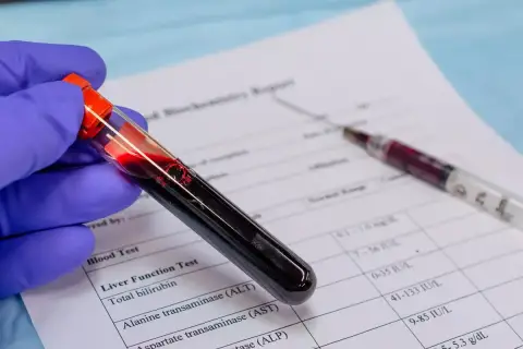 Ręka w niebieskiej rękawiczce trzyma probówkę z krwią, obok leży strzykawka i wyniki badań. To badanie krwi u psa.